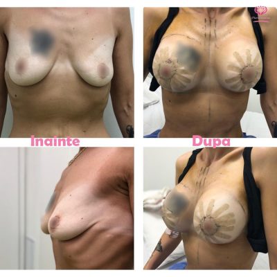 augmentare si mastopexie