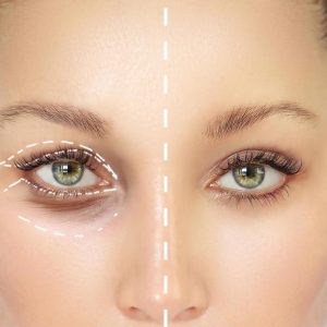 blefaroplastie-113 blefaroplastie-113