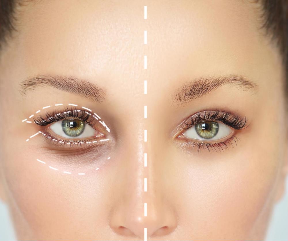 Blefaroplastie pleoapă superioară și inferioară