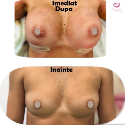 Augmentare