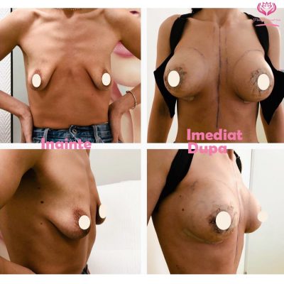 Augmentare cu mastopexie-min