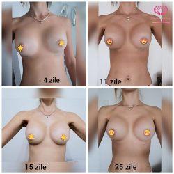 augmentare mamara 1