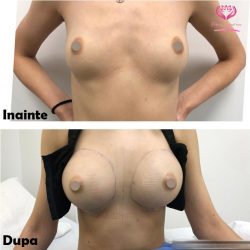 augmentare mamara 2