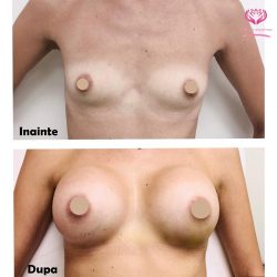 augmentare mamara