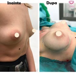 augmentare mamara cu proteze de silicon dual plane-min