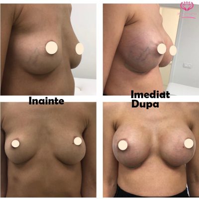 augmentare submusculara dual pane-min