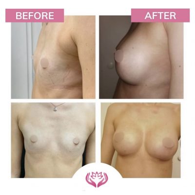 Augmentare cu implant silicon
