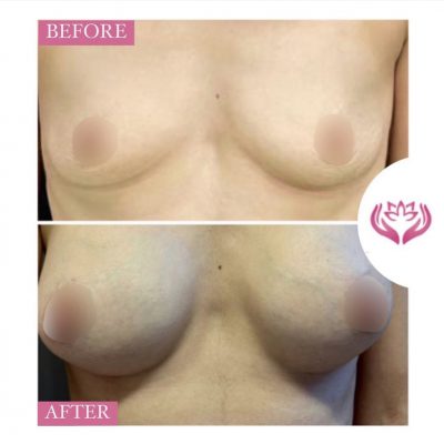 Augmentare mama cu implant silicon