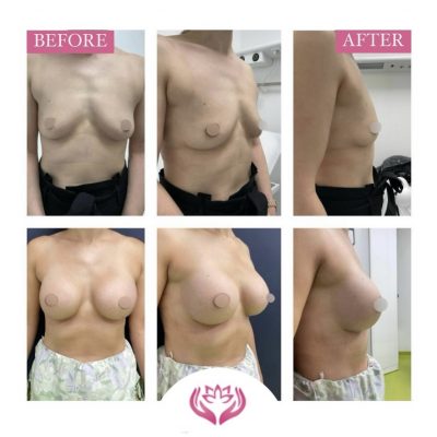 Augmentare mamara cu implant silicon