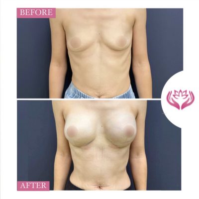 Augmentare mamara cu implant silicon(1)