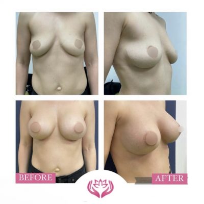 Augmentare mamara cu implant silicon(3)