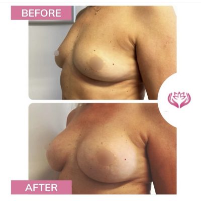 augmentarea mamara cu implant silicon