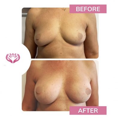 augmentarea mamara cu implant silicon(1)