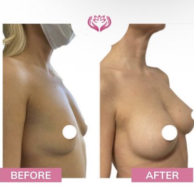 augmentarea mamara cu implant silicon(2)