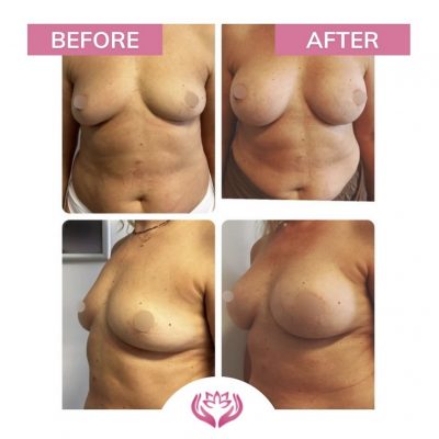 augmentarea mamara cu implant silicon(3)